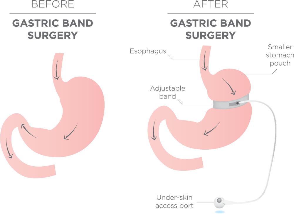 Gastric Band Surgery diagram