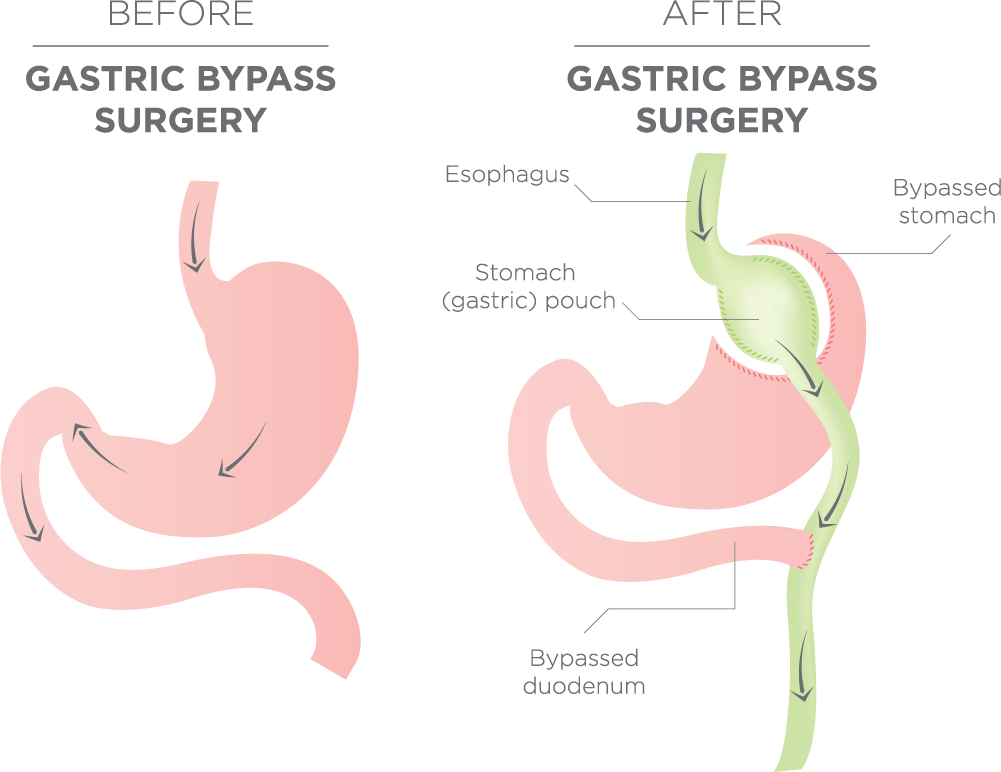 Gastric Bypass diagram
