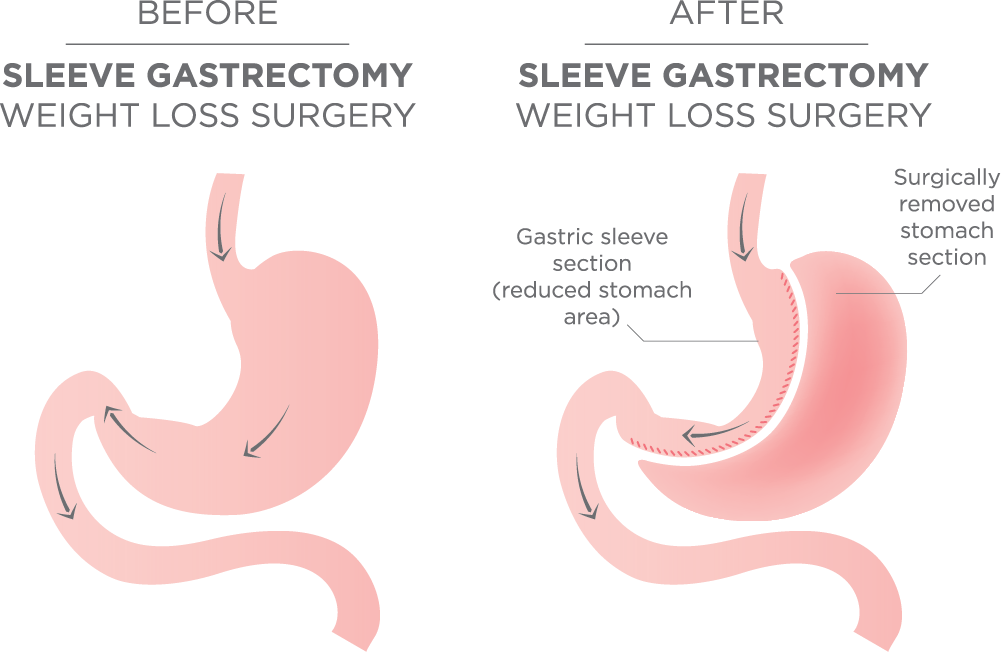 Sleeve Gastrectomy diagram